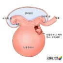 난소생식세포종양 이미지