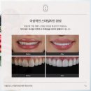 스마일100치과 네이버블로그