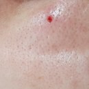 이은피부과의원 | 사마귀, 편평사마귀, 쥐젖 치료시술 후기