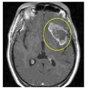 뇌암과 양성뇌종양의 차이점 [뇌종양] 이미지