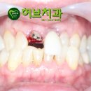 허브치과기공소 티스토리