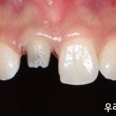 광교웃음진치과의원 | 광교 앞니 크라운 잘하는치과 ; 잇몸 검은 라인 해결법, 금속 기둥 제거와 실활치 미백