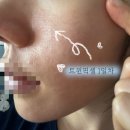 펄스코 | 울트라펄스알파 울트라클리어 레이저 알아보다가 트윈픽셀 받고 온 솔직 후기