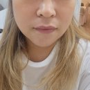 쌍용리페어 | 아산피부관리 ‘가람뷰티’ 울쎄라 하이푸 3000샷 리얼 후기