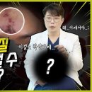 강남역 다움성형외과 후기: 이물질 제거 후, 이걸로 완성된다?