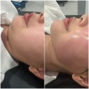 트리플 | 대구피부과 고현정리프팅 텐트리플 리얼후기