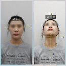 천호한의원 | [서울/천호] 천호안면비대칭교정 한의원 비대칭교정치료 후기