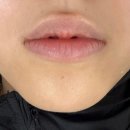 수영에스테틱 | 부산 수영 망미 에스테틱 입술 관리 후기 스킨릿 립퍼밍