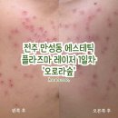 경보시스템~피지텍 | 전주피부관리 만성동 오로라숲ㅣ기미, 잡티 플라즈마 레이저로 제거하기ㅣ여드름 압출은 덤