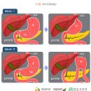 위암의 치료방법/위암 치료의 부작용/항암화학요법 후의 부작용/방사선치료 후의 부작용 이미지