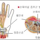 팔,다리 저림 이미지