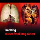 폐암의 대해 모든것 알아봅시다 이미지
