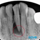 세브란스이치과의원 | 과천 자연치아 살리는 치과, 염증 있는 앞니 꼭 빼야 할까요? <연세세이브치과>
