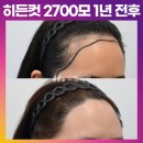 [20대 여자 무용과 넓은 헤어라인 모발이식] 무삭발 비절개 히든컷 2700모 1년 후기 (모엠의원/헤어라인/전지훈원장) 이미지