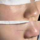 김경희피부관리실 | 부천 상동여드름압출 제대로 관리하면 이렇게 달라집니다.