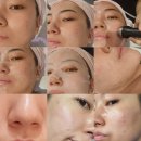 오산대역 미올린 MIOLLIN 오산피부과 (예스필로 LDM재생 피부관리)