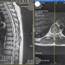흉추 mri 봐주세요... 이미지