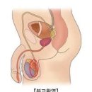 고환 통증 원인 고환암 부고환염 고환염전 증상 이미지