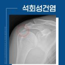 바른윤오마취통증의학과의원 | 신방화역정형외과 갑작스러운 어깨 통증, 석회성 건염 의심해야