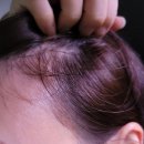 (주)헬스허브 | M자 정수리 탈모, 리바이탈래쉬 1년 6개월 비포 에프터 후기 (ft. 레스노베 하이퍼샷, 맥주효모⚡️)