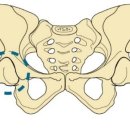 고관절통증//대퇴골두무혈성괴사 알아보기!! 이미지