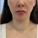 순자헤어샵 | 강남역 피부과 나솔24기 순자 리프팅 올타이트 후기 리쥬란 효과