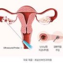 난소기형종 난소혹 원인 수술(자궁 초음파, 하복부통증) 이미지