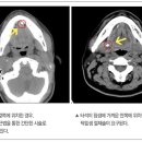 침샘에 생기는 타석증 이미지