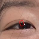 바른뿌리한의원 | 홍제역 한의원에서 편평사마귀 뺐따