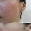 압구정 피부관리추천 트러블케어 -&gt; 맑은피부로