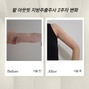 집밥멍선생 | 신사역성형외과 아웃핏지방추출주사후기｜붓기 빠지는 시기? 뼈팔 2주차 변화