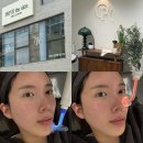 클리어스킨 | 강남역 피부관리 프리베 더 스킨 모공삭제 포어클리어 후기