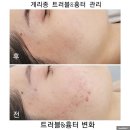 아름다울 스킨앤바디 | 송파에스테틱 본스킨앤바디 후기 게리종테라피 체험기