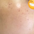 순한의원 | [압구정 루나의원] 레이저 542샷, 시술 직후 부터 6개월 후까지 내돈내산 후기 (+꿀팁까지)