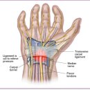 수근관 증후군(Carpal Tunnel Syndrome) 이미지