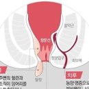 피똥 싸는이유 원인 장염 변비 치질 뭘까 이미지