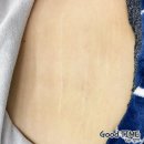 [청주피부관리] 튼살제거 전문 이츠제이 청주점에서 튼살관리했어요~