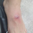 "봉와직염 Cellulitis" 이미지