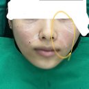 생성하고 팔자주름 없앨 수 있을까? (피부과 원장님 꿀팁, 가격, 장단점, 부작용) 내돈내산 솔직후기