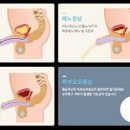 전립선염 효능 및 증상 원인 이미지