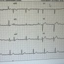 이거 정상 심전도 리듬이야?? 이미지