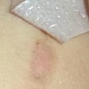 상인제이스성형외과의원 | 풀리오 어깨 마사지기 저온화상 치료 한티역 한강수성형외과 병원 후기