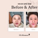 오룡역 7번출구 옆 | 부산 서면 피부과 이중턱 고민 해결, 서면 인모드 잘하는 곳 솔직 후기 (전후 사진 비교)