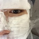 블랑쥬의원 | [블랑쥬의원 강남] 얼굴 편평사마귀 50개 레이저 시술 내돈내산 후기 (시술 직후, 2, 5, 10, 17일)