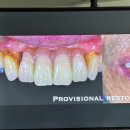 하이(HI)치과기공소 | #005 이승섭소장님 옵티쉐이드 특강 (24.09.28)