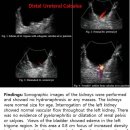 Distal ureteral calculus 이미지