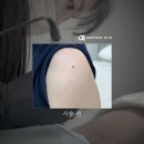 하얀달 | 여자 어깨 하얀튼살 커버 후기, 여름 민소매 입기 전 고민 해결 사례