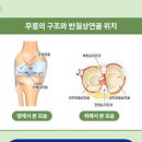 무릎연골찢어짐 반월상연골파열 연골연화증 증상 원인 통증 치료 이미지