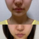 더피앤에이치 | 50번째 취향 : 홈케어 리프팅기기 사용 후기[마이푸(MIFU)]