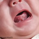 ABC김광우소아과 | 포항 쌍둥이 설소대 시술 후기 [포항 ABC김광우 소아과]